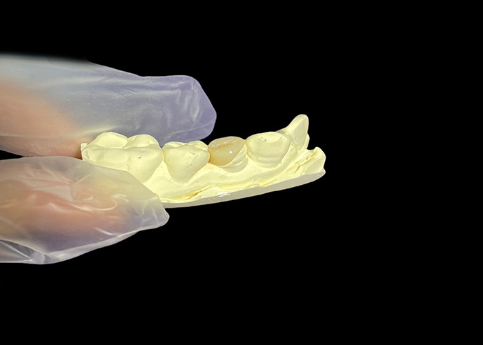Inlay dentaire en céramique Onlay pour une réparation efficace des dents avec des solutions de porcelaine durables et esthétiques pour une restauration durable