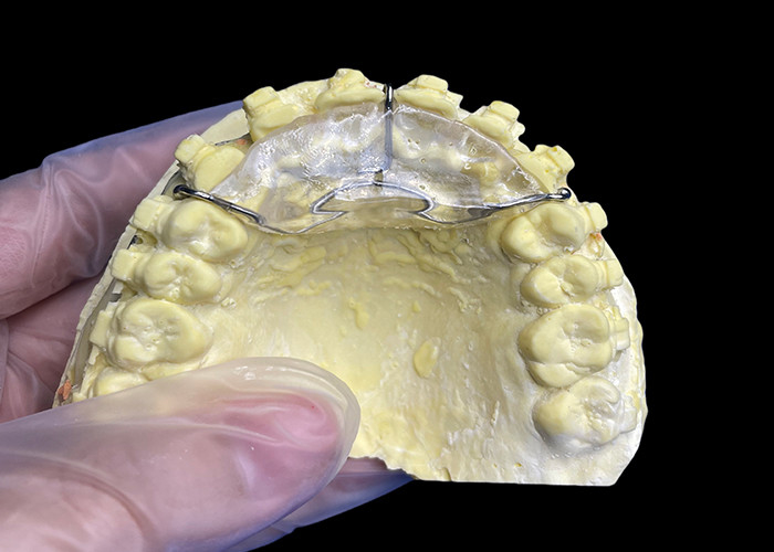 Appareils orthodontiques sur mesure pour le plan de morsure pour corriger les problèmes de morsure ou pour soulager la pression sur l'articulation de la mâchoire.