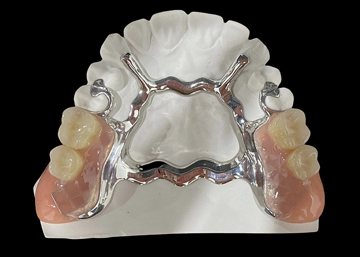 Prothèse partiellement amovible à base métallique et résine acrylique pour une apparence naturelle et sûre