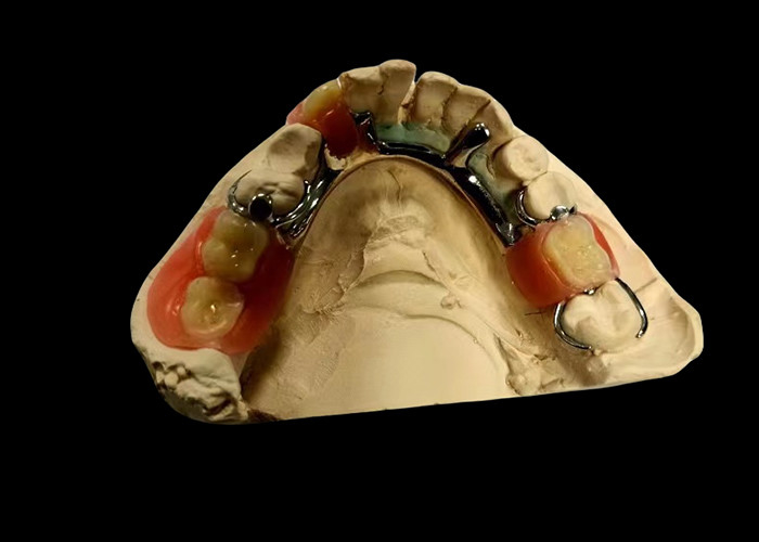 Prothèse partiellement amovible à base métallique et résine acrylique pour une apparence naturelle et sûre