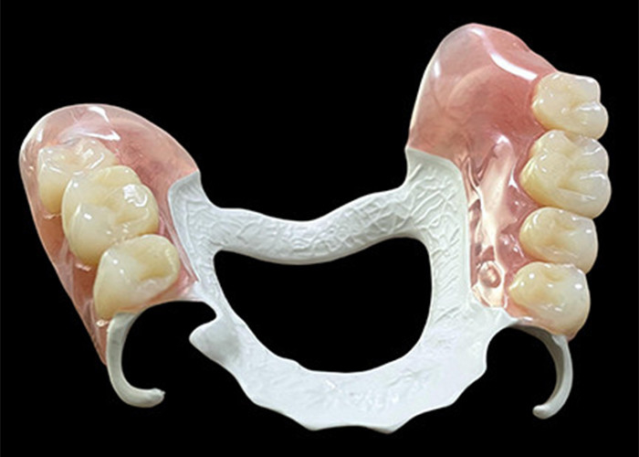 Prothèse partiellement amovible personnalisée avec cadre en polymère haute performance (HPP) pour un confort et une durabilité supérieurs