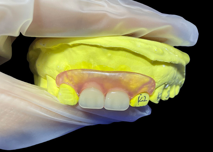 Prothèse paritale flexible pour mâcher et parler confortablement