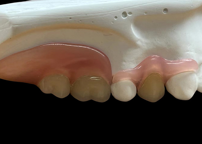 Dentures flexibles invisibles réglables: confortables pour mâcher et parler avec une durabilité variable