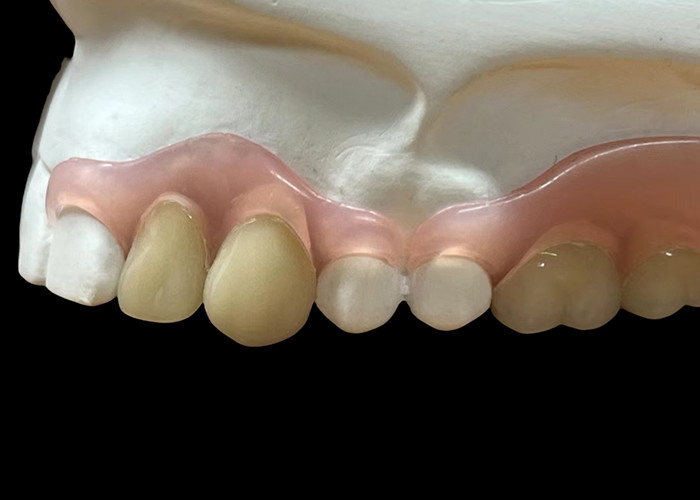 Dentures flexibles invisibles réglables: confortables pour mâcher et parler avec une durabilité variable