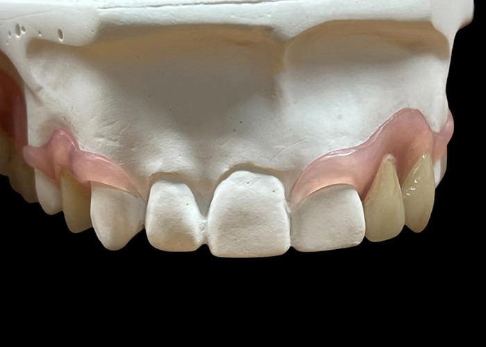 Prothèse paritale flexible pour mâcher et parler confortablement
