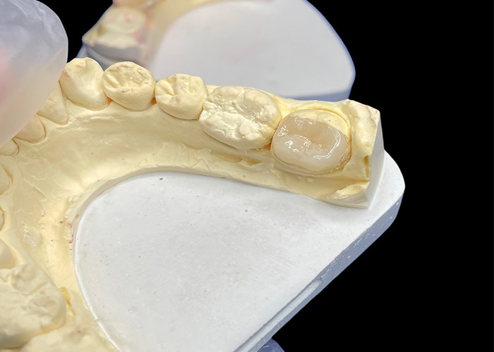 IPS e.max Incrustations et oncrustations céramiques pour la restauration molaire Esthétique naturelle et durabilité supérieure pour des résultats durables