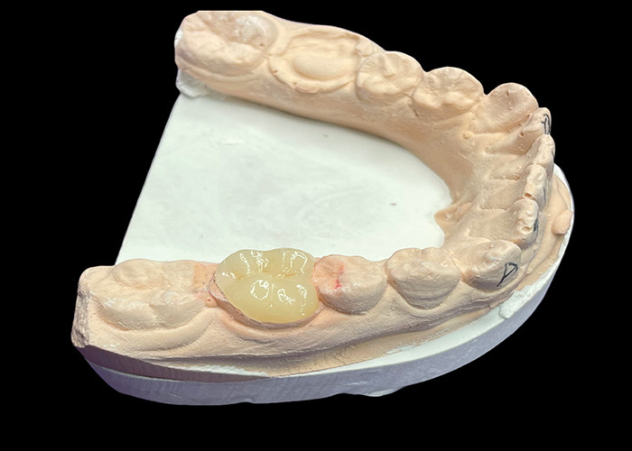 Incrustation en céramique dentaire lisse sur mesure pour la réparation des dents sans couture résistante à la coloration et l'esthétique naturelle