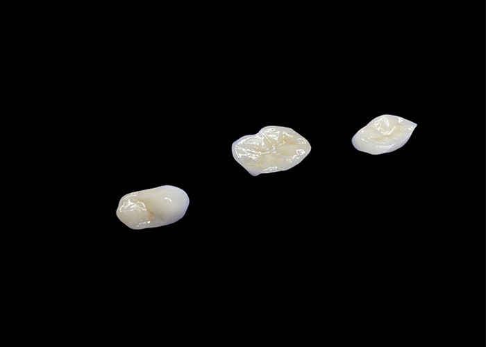 Les incrustations et les incrustations en céramique biocompatibles conçues pour une durabilité confortable et une intégration transparente avec les dents naturelles