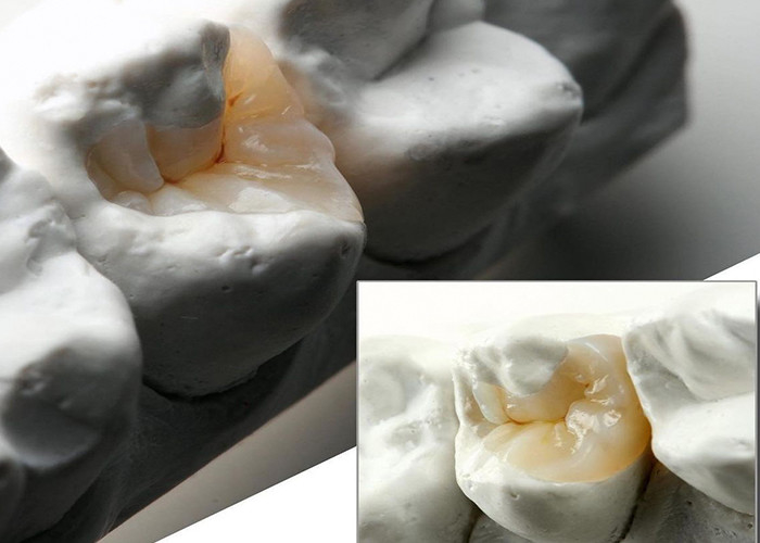 Des incrustations et des onlays en céramique naturelles pour une restauration dentaire précise de notre laboratoire dentaire expert