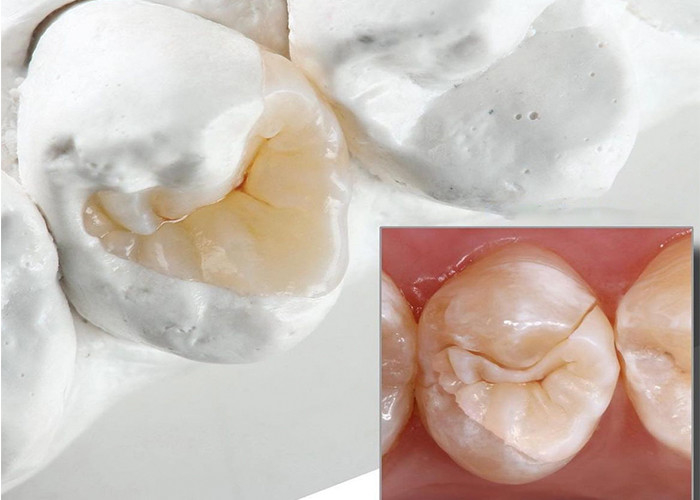 Des incrustations et des onlays en céramique naturelles pour une restauration dentaire précise de notre laboratoire dentaire expert