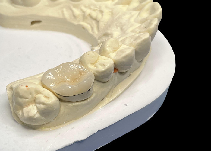 Porcelaine hypoallergénique encrés encrés pour les dents, couleur naturelle et entretien facile