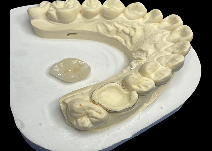 Inlay dentaire en céramique Onlay pour une réparation efficace des dents avec des solutions de porcelaine durables et esthétiques pour une restauration durable