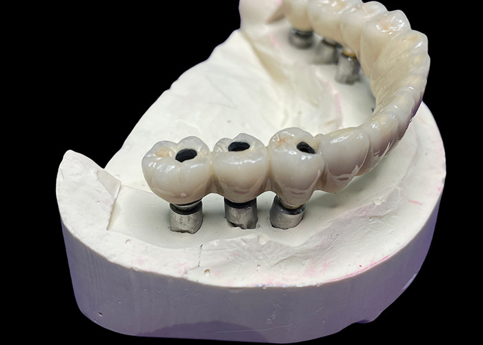 L'implant dentaire avec une base en titane est surmonté d'un magnifique pont de couronne en céramique pour créer une restauration parfaite.