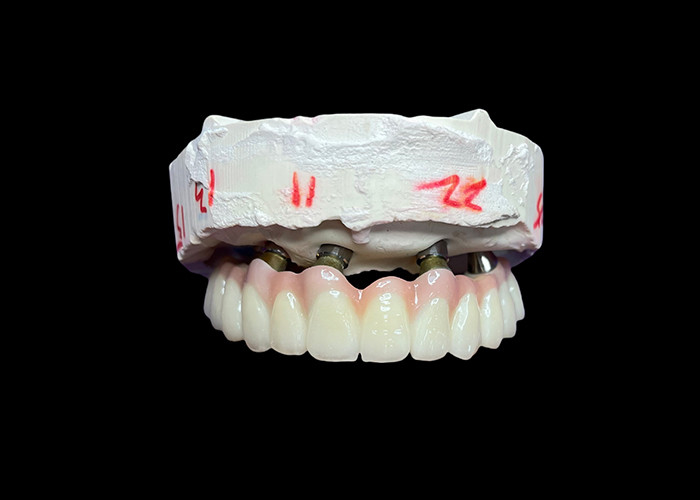 Implantation dentaire, prothèses dentitaires fixes à arc complet pour une solution permanente, stable et naturelle aux dents manquantes