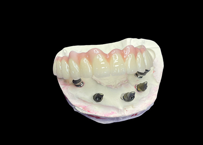 Implantation dentaire, prothèses dentitaires fixes à arc complet pour une solution permanente, stable et naturelle aux dents manquantes