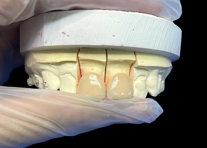 Résistance de précision EMAX Porcelaine Veneer incisif pour les restaurations esthétiques naturelles