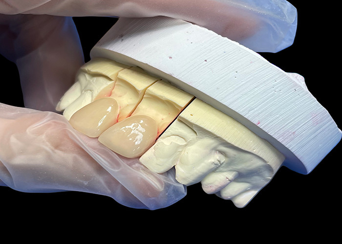 Résistance de précision EMAX Porcelaine Veneer incisif pour les restaurations esthétiques naturelles