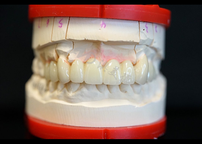 Résistance Esthétique naturelle Couronne en zirconium solide Parfait pour une ou plusieurs dents
