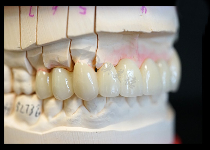 Résistance Esthétique naturelle Couronne en zirconium solide Parfait pour une ou plusieurs dents