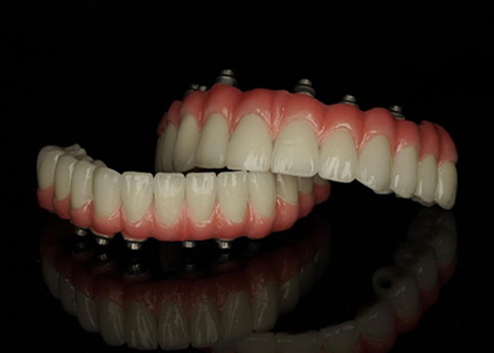 Prothèses dentaires à base de titane à support d'implant fixe avec pont de couronne en céramique pour remplacer les dents manquantes