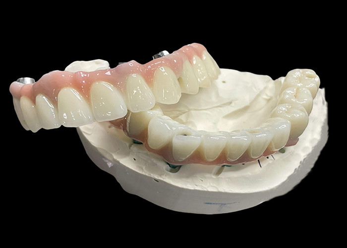 Prothèses dentaires à base de titane à support d'implant fixe avec pont de couronne en céramique pour remplacer les dents manquantes