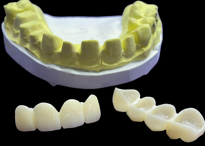 Des couronnes et des ponts en porcelaine dentaire résistantes aux taches dans des nuances Vita classiques pour une esthétique naturelle
