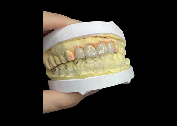 Des couronnes et des ponts en porcelaine dentaire résistantes aux taches dans des nuances Vita classiques pour une esthétique naturelle