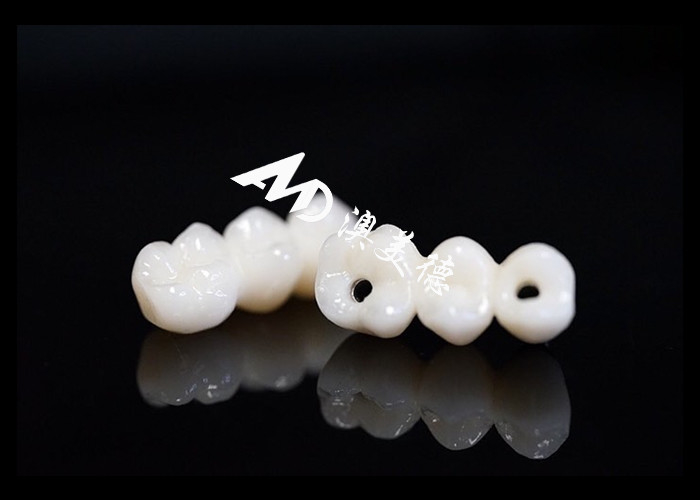 Implantation dentaire naturelle pont de couronne fixé avec un piédestal en titane pour la chirurgie des dents manquantes