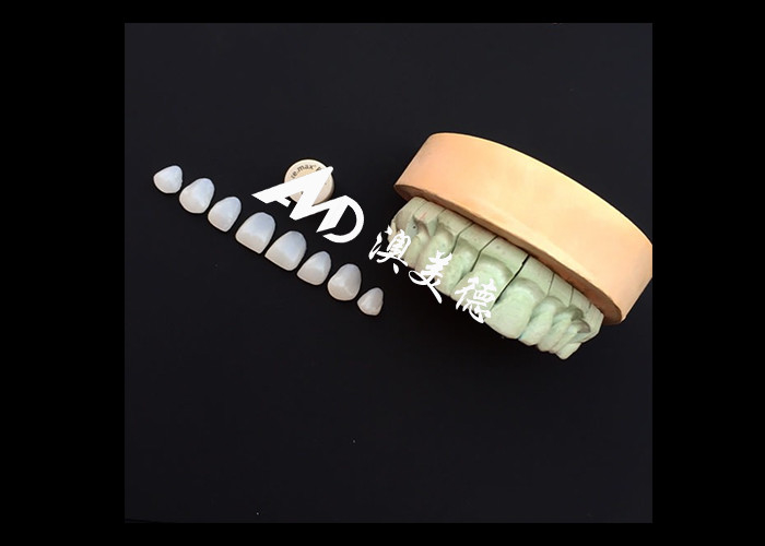 Transformez votre sourire avec IPS emax Veneurs de porcelaine de presse Force esthétique et durabilité combinées