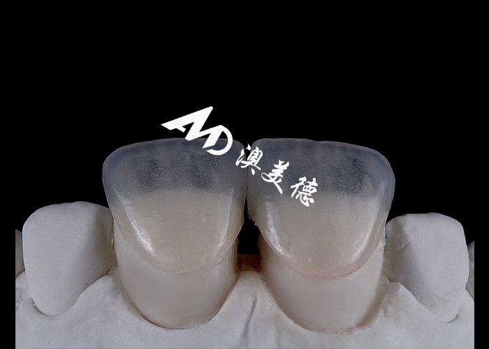 Transformez votre sourire avec IPS emax Veneurs de porcelaine de presse Force esthétique et durabilité combinées