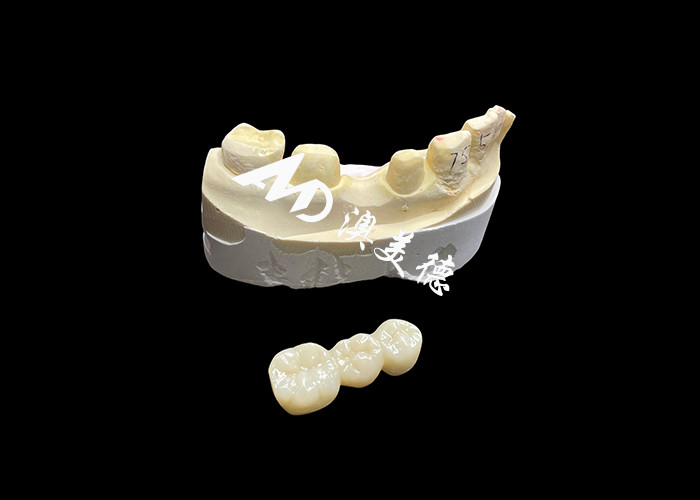 Couronne dentaire en zirconium esthétique de haute dureté avec translucide et résistance aux fissures du laboratoire dentaire chinois