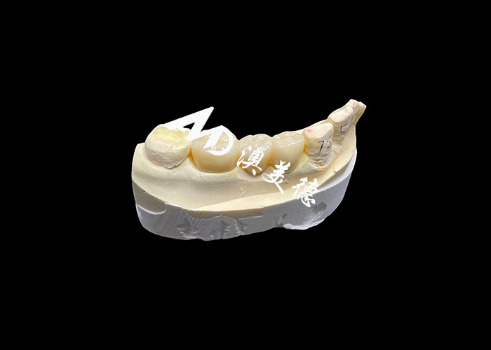 Couronne dentaire en zirconium esthétique de haute dureté avec translucide et résistance aux fissures du laboratoire dentaire chinois