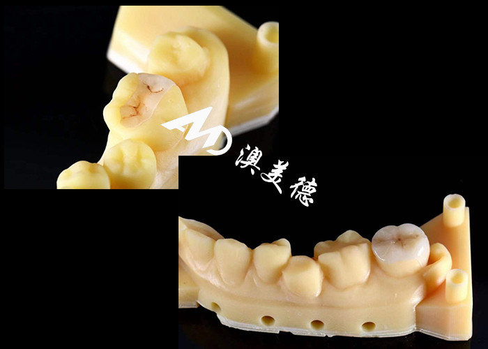 Inlays et onlays en céramique de précision pour la réparation des dents avec des couleurs naturelles, un matériau hypoallergénique et un ajustement sans couture pour un confort et une durabilité supérieurs