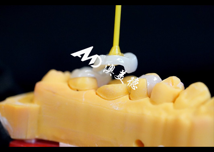 Inlays et onlays en céramique de précision pour la réparation des dents avec des couleurs naturelles, un matériau hypoallergénique et un ajustement sans couture pour un confort et une durabilité supérieurs