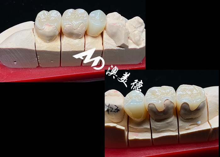 OEM Inlays céramiques de précision pour les restaurations dentaires durables et naturelles avec une résistance et une fiabilité supérieures
