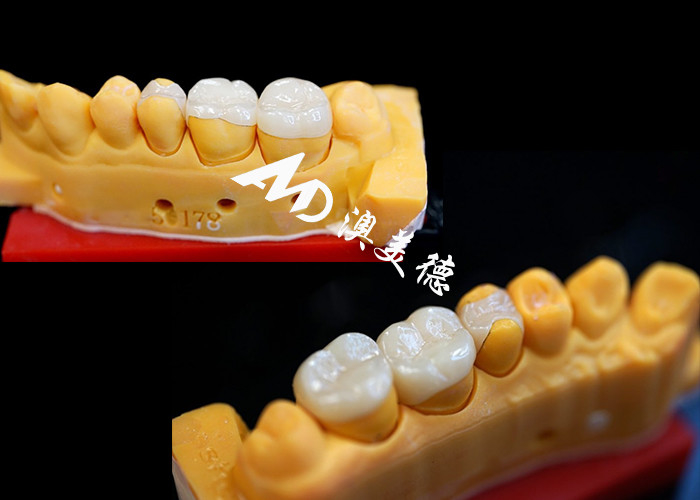 OEM Inlays céramiques de précision pour les restaurations dentaires durables et naturelles avec une résistance et une fiabilité supérieures