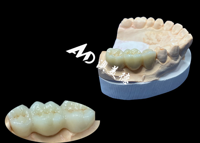 Une couronne dentaire en zirconium de couleur naturelle résistante aux fissures pour un sourire impeccable