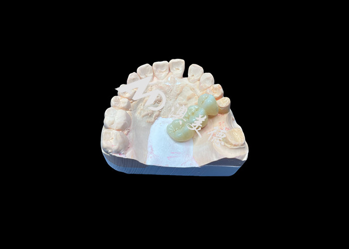 Une couronne dentaire en zirconium de couleur naturelle résistante aux fissures pour un sourire impeccable