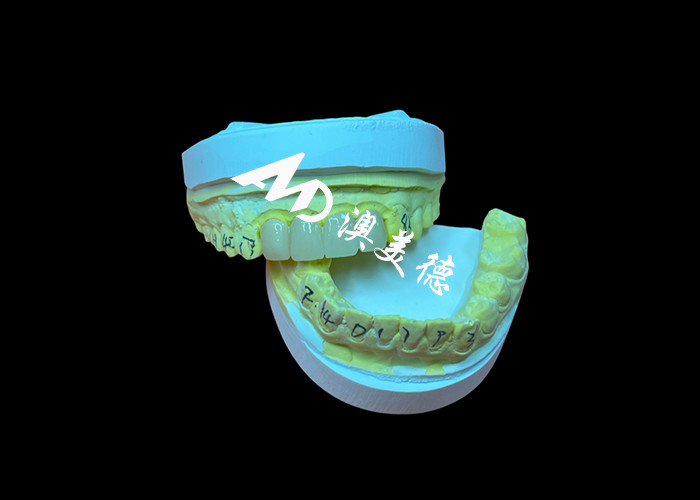 Restauration dentaire Couronne dentaire en zirconium translucide pour un ajustement précis et une esthétique naturelle