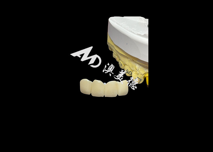 Restauration dentaire Couronne dentaire en zirconium translucide pour un ajustement précis et une esthétique naturelle