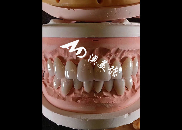 Dentisterie cosmétique EMAX Faisceaux dentaires de 0,3-0,5 mm d'épaisseur pour les restaurations esthétiques