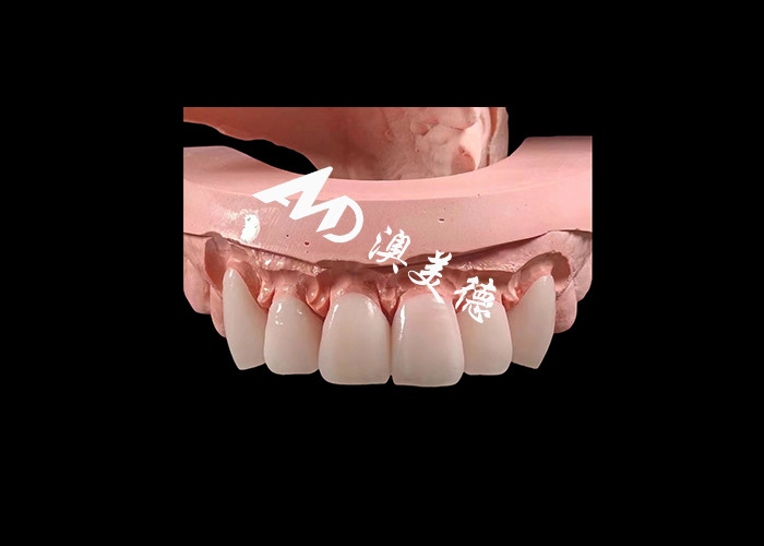 Dentisterie cosmétique EMAX Faisceaux dentaires de 0,3-0,5 mm d'épaisseur pour les restaurations esthétiques