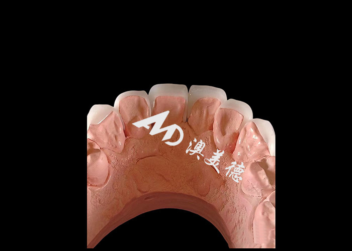 Dentisterie cosmétique EMAX Faisceaux dentaires de 0,3-0,5 mm d'épaisseur pour les restaurations esthétiques