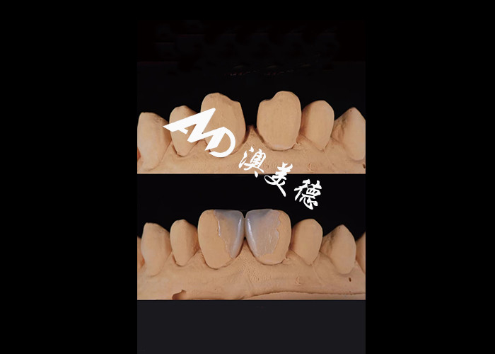 0.3-0.5mm Ultra mince IPS EMAX Porcelaine Veneers pour le maquillage esthétique sourire