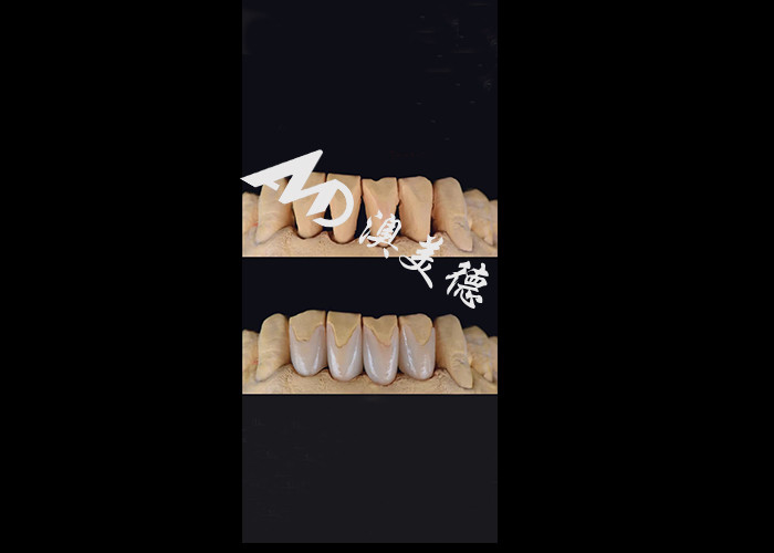 0.3-0.5mm Ultra mince IPS EMAX Porcelaine Veneers pour le maquillage esthétique sourire