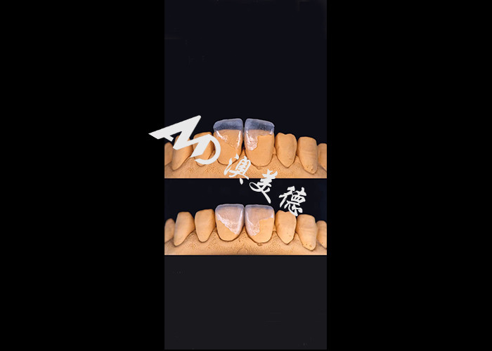 0.3-0.5mm Ultra mince IPS EMAX Porcelaine Veneers pour le maquillage esthétique sourire