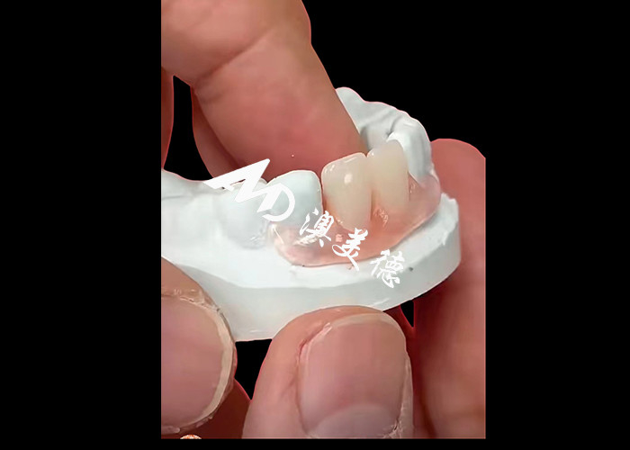 Les prothèses flexibles Nesbite offrent une solution sans couture pour un sourire confortable et naturel.