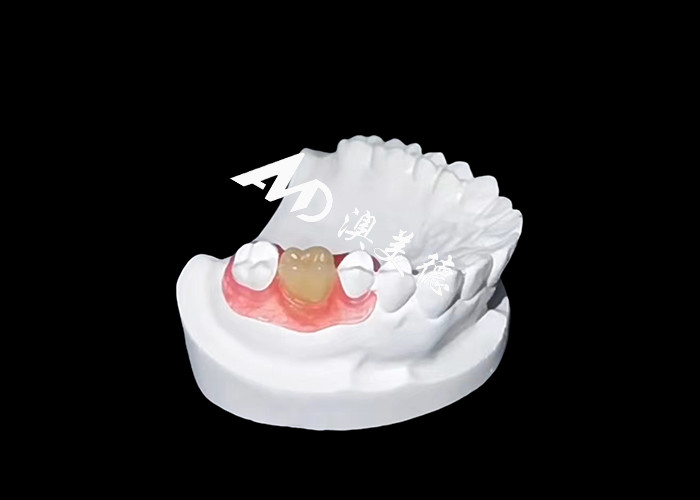 Les prothèses flexibles Nesbite offrent une solution sans couture pour un sourire confortable et naturel.