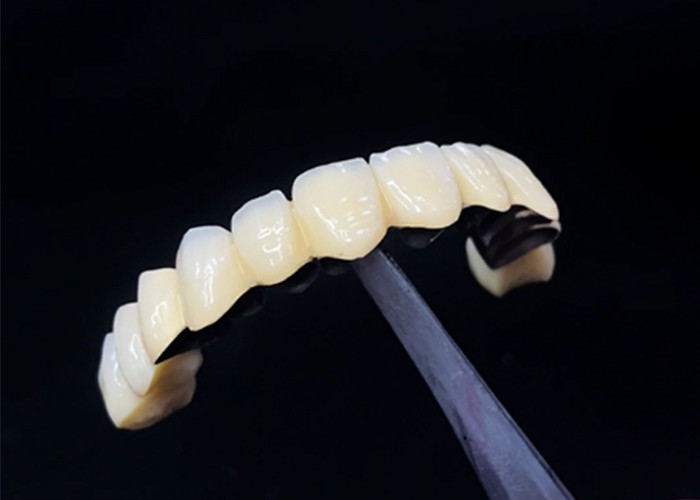 La porcelaine fondue dans une couronne métallique combine durabilité et beauté pour la santé dentaire