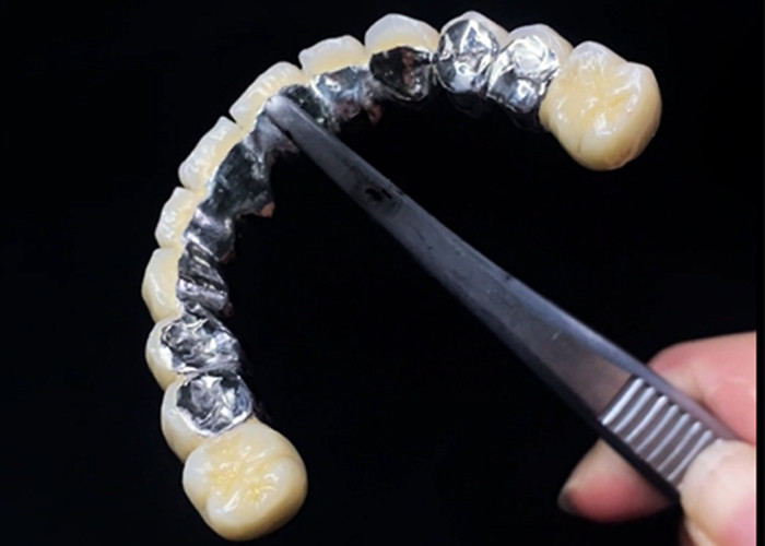 La porcelaine fondue dans une couronne métallique combine durabilité et beauté pour la santé dentaire